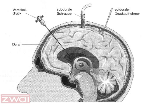 Abb. 6: Methoden zur Messung des intrakraniellen Drucks (ICP). Im Seitenventrikel, subdural oder epidural (von links nach rechts).